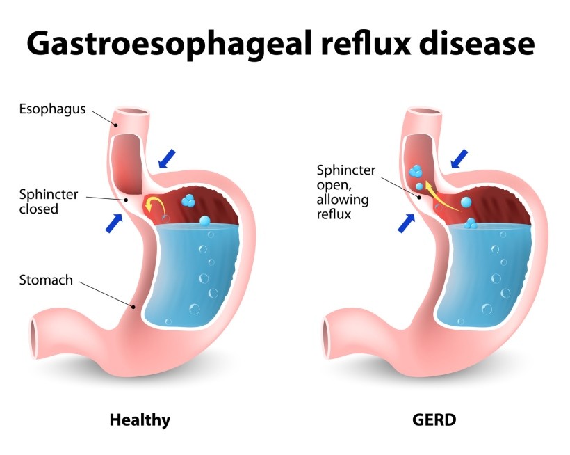 Long Term use of GERD Meds are Unsafe DrCarney Blog