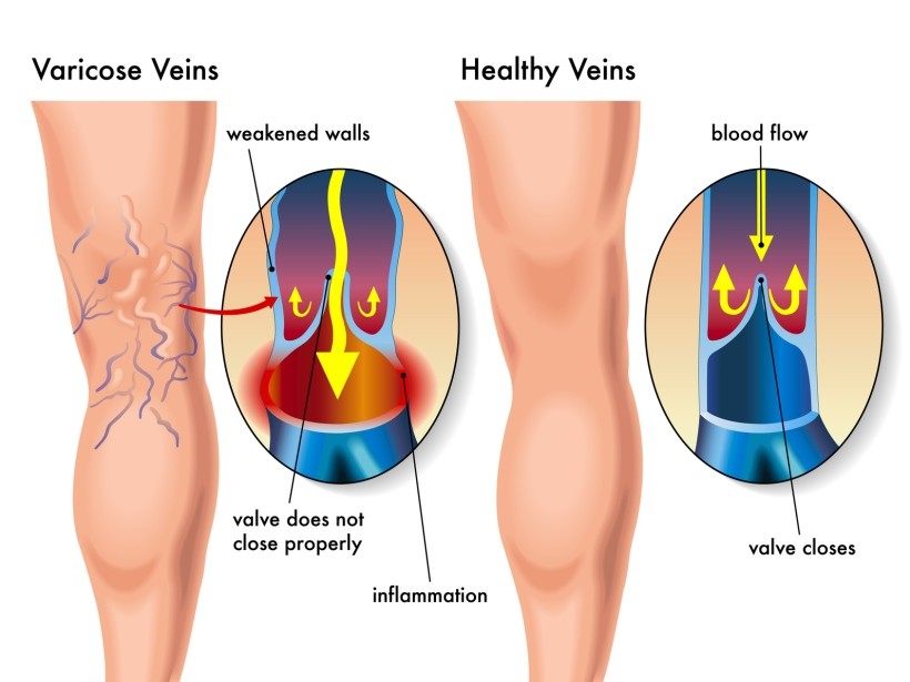 How Does Being Constipated Promote Varicose Veins DrCarney