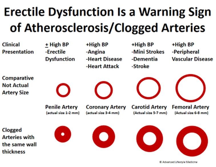 ED is a Warning Sign of Clogged Arteries DrCarney Blog